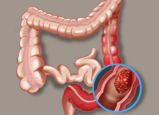 Dormir Mal Podría Acelerar el Avance del Cáncer Colorrectal: Qué Descubrió un Novedoso Estudio